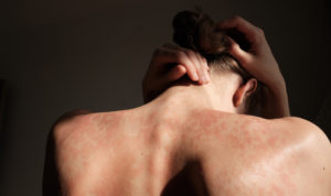 femme avec de l'eczema dans le dos